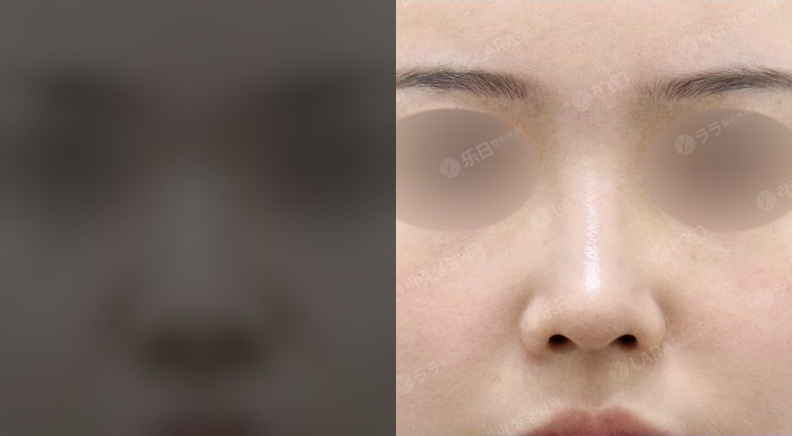 콧대,코끝 + 복코,비주 교정 (Before 잠금 · After 1M)
