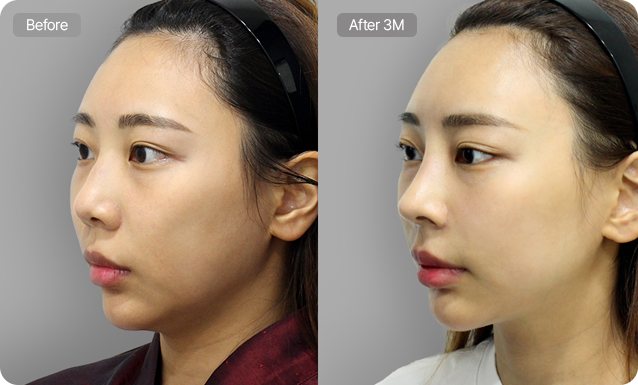 코성형 전후 45도 옆얼굴 — Before / After 3M (콧대,코끝 + 복코,짧은코 교정 + 콧볼축소)