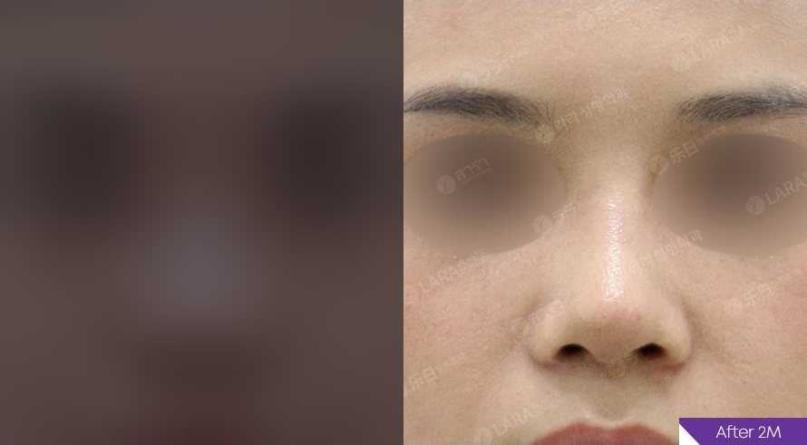 코성형 전후 정면(눈 가림) — Before / After 2M — 콧대,코끝 + 복코,비주,매부리 교정 (Before 잠금)
