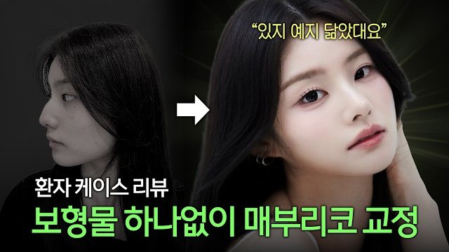 유튜브 썸네일 — 보형물 하나 없이 매부리코 교정? 원장도 놀란 무보형물 코성형 실제 케이스 | 라라성형외과