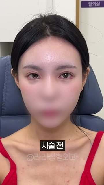 라라성형외과 쇼츠 썸네일 — 요즘 제일핫한 눈필러 3종 후기