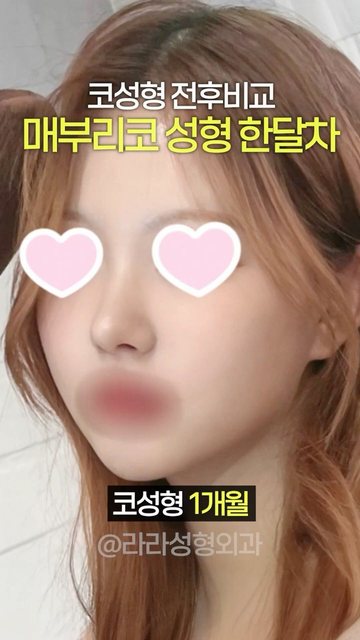 라라성형외과 쇼츠 썸네일 — 매부리코 성형 한달차 후기