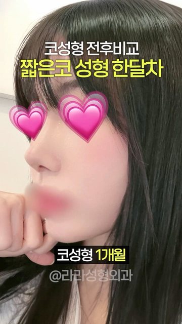 라라성형외과 쇼츠 썸네일 — 짧은코 성형 한달차 후기