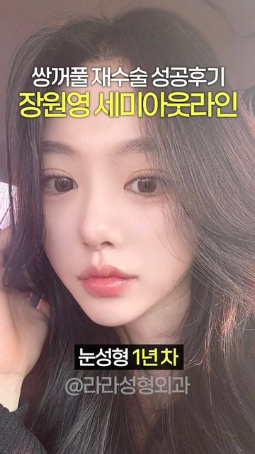 라라성형외과 쇼츠 썸네일 — 장원영 세미아웃라인 쌍꺼풀 재수술 후기