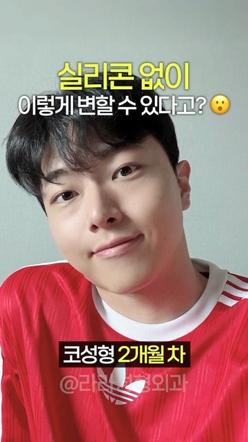 라라성형외과 쇼츠 썸네일 — 실리콘없이 코성형 어디까지 가능?