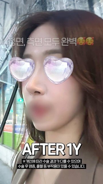 라라성형외과 쇼츠 썸네일 — 복코수술 성공후기
