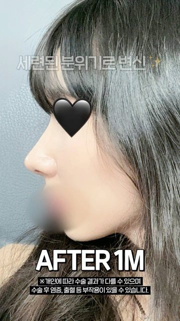 라라성형외과 쇼츠 썸네일 — 심한 매부리코 무보형물 코성형 후기