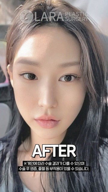 라라성형외과 쇼츠 썸네일 — 중안부가 짧아보이는 무보형물 긴코성형