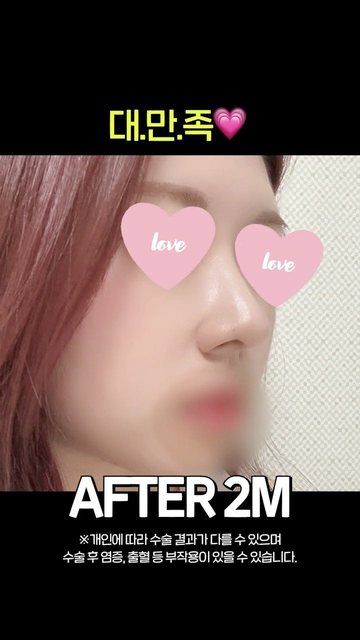 라라성형외과 쇼츠 썸네일 — 분위기가 확달라지는 복코+매부리코 성형후기