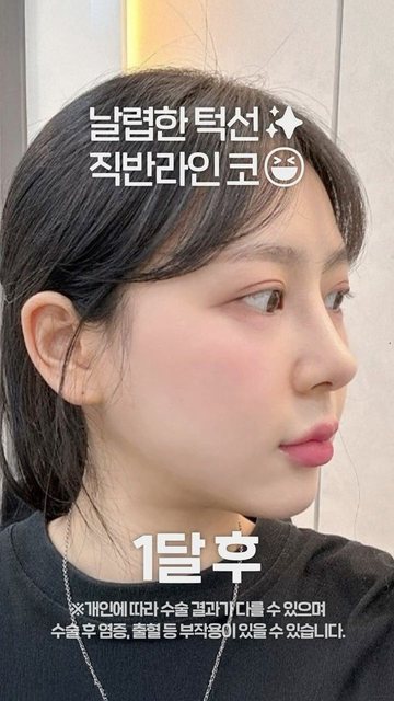 라라성형외과 쇼츠 썸네일 — 코성형+얼굴지방성형 후기