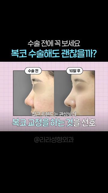 유튜브 쇼츠 썸네일 — 복코 수술해도 관상에 괜찮을까?