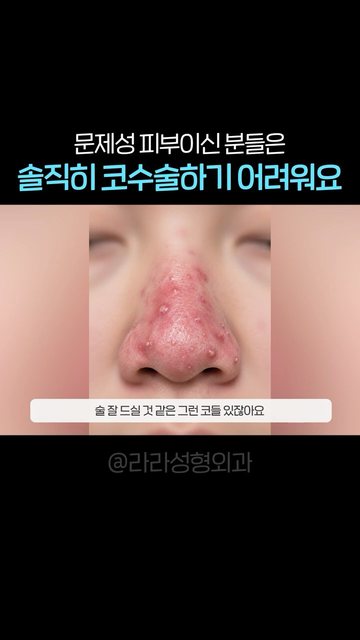 유튜브 쇼츠 썸네일 — 솔직히 코수술하기 어려운 케이스